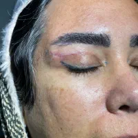 برداشت پلک بالا و‌پایین و نامه برای بیمه