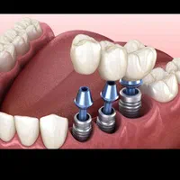 ایمپلنت (دندان ثابت) با بالاترین کیفیت وقیمت خیریه|خدمات آرایشگری و زیبایی|زاهدان, |دیوار