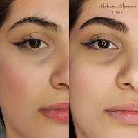 مدل میکروبلیدینگ