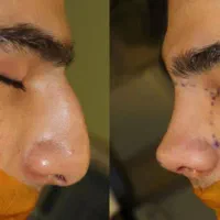 جراحی بینی در مجهز ترین کلینیک بدون تامپون|خدمات آرایشگری و زیبایی|تهران, شهر زیبا|دیوار