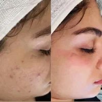 درمان قطعی و دائمی جوش