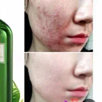 اف ویژه پاکسازی فیشیال*vip* تخصصی درمانی از350