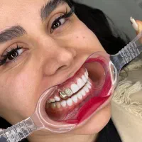 جشنواره ونیر کامپوزیت لمینیت روکش دندان عصب IPS
