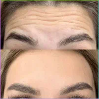 کاشت ابرو/فیشال/تزریق فیلر/لیپوابدو/پی ار پی|خدمات آرایشگری و زیبایی|پیشوا, |دیوار