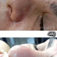 مدل برای روشن سازی صورت و از بین بردن جوش|خدمات آرایشگری و زیبایی|مسجد سلیمان, |دیوار