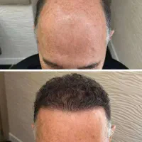 از دم قسط کاشت مو و ابرو بلفاروغبغب کلینیک حس زیبا|خدمات آرایشگری و زیبایی|اصفهان, سعادت‌آباد|دیوار