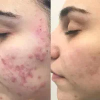 فیشال و پاکسازی پوست|خدمات آرایشگری و زیبایی|محمدشهر, محمدشهر|دیوار