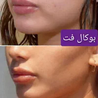 غبغب بوکال لیفت شقیقه سانترال چربی ژل بوتاکس|خدمات آرایشگری و زیبایی|شیراز, قدوسی غربی|دیوار