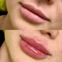 تزریق ژل و بوتاکس توسط پزشک لیزر موهای زاید|خدمات آرایشگری و زیبایی|تهران, هفت حوض|دیوار