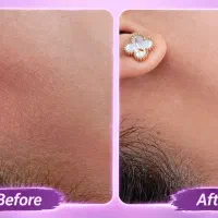 خدمات و اموزش فیشال اسکراب اسکالپ الگاپیل جوانسازی