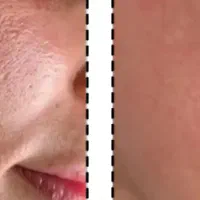 خال برداری ومزونیدلینگ وپلاسما|خدمات آرایشگری و زیبایی|قم, نیروگاه|دیوار