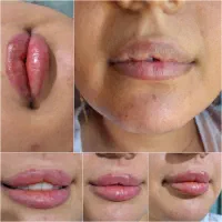 مدل برای فیلر