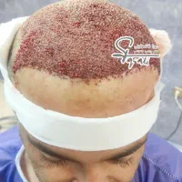 کاشت مو پر تراکم