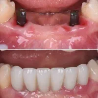 ایمپلنت کره درجه یک