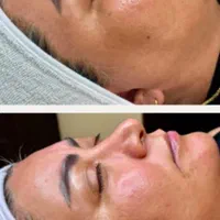 پاکسازی و فیشیال تخصصی و پلاژن تراپی ( فیشال )|خدمات آرایشگری و زیبایی|شیراز, شهرک قمشه|دیوار