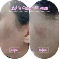 پاک کردن تتو///خدمات لیزر کیوسوئیچ و پیلینگ کربن|خدمات آرایشگری و زیبایی|صدرا-فارس, فاز ۱|دیوار