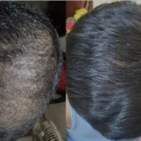 قطع ریزش ورشد مجدد مو باسلول بنیادی توسط پزشک نخبه|خدمات آرایشگری و زیبایی|اصفهان, آبشار|دیوار