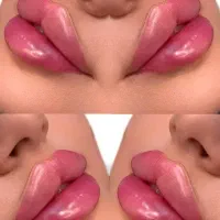 پزشک مزو ژل بوتاکس لب گونه چشم چانه زاویه فیلر prp