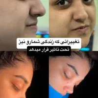 آف زیبایی لیپو ابدو عمل بینی ۱۹ میلیون|خدمات آرایشگری و زیبایی|خرمشهر, |دیوار
