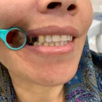 دندان مصنوعی (پروتز)|خدمات آرایشگری و زیبایی|گالیکش, |دیوار