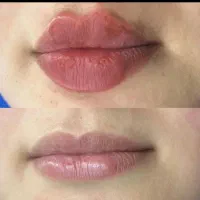 اف  انواع تزریق ژل باکمترین قیمت پاک کردن ابرو