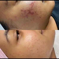 آموزش،فیشیال،پاکسازی تخصصی،جوانسازی صورت بانوان|خدمات آرایشگری و زیبایی|کرمانشاه, |دیوار