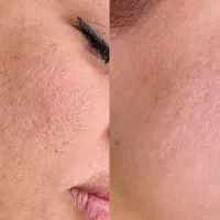 جوانسازی ورفع جای جوش بامیکرونیدلینگ کلینیک زیبایی