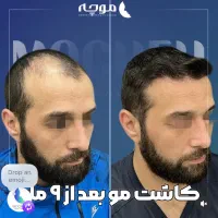 کاشت مو بدون جراحی یک روزه ضمانت مادام العمر|خدمات آرایشگری و زیبایی|تهران, ونک|دیوار