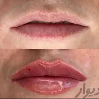 تزریق فیلر بادی (هیپ دیپ،باسن)