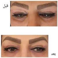 لیزرموهای زائدبادستگاه آلمانی+فیلر+بوتاکس+مزوتراپی|خدمات آرایشگری و زیبایی|کرمان, |دیوار