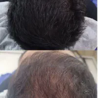 میکرواسکالپ ،اسکالپ vip تخصصی در کلینیک پوست ومو