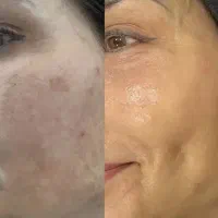 پاکسازی پوست ودرمان لک