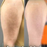 درمان کامل انواع لک پوستی توسط پزشک|خدمات آرایشگری و زیبایی|اصفهان, سعادتآباد|دیوار