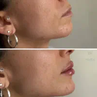 لیفت جراحی بینی بلفارو ژل لب بوتاکس مزو فشیال|خدمات آرایشگری و زیبایی|شاهین‌شهر, طالقانی|دیوار