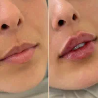 تزریق‌ ژل لب فیلر بادی بوتاکس لیفت صورت زاویه مزو