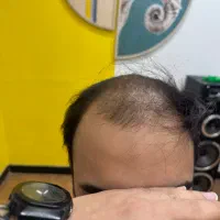 پروتز مو فروش و تعمیرات تخصصی|خدمات آرایشگری و زیبایی|تهران, تهرانپارس غربی|دیوار