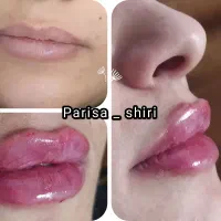 ژل، فیلر لب ۵۰۰،آنزیم ۳۵۰،زاویه ،بوتاکس۴۵۰|خدمات آرایشگری و زیبایی|قم, تولید دارو و یخچال|دیوار