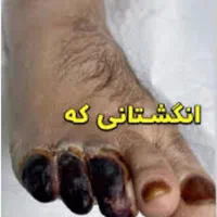 بهبودی کامل دیابت بدونه نیاز به قرص