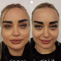 بلفاروپلاستی رفع افتادگی پلک لیزری/سانترال/بوکالفت|خدمات آرایشگری و زیبایی|تهران, هفت حوض|دیوار