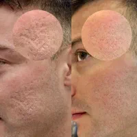 پاکسازی تخصصی پوست مردانه رفع جوش و چربی پوست