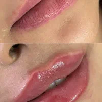 تزریق ژل وبوتاکس ومزو ژل با قیمت مناسب ژل ۷۰۰