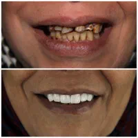 دندانپزشکی ونیر کامپوزیت و لمینت با شرایط پرداخت|خدمات آرایشگری و زیبایی|اصفهان, احمدآباد|دیوار