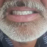 ساخت عنواع دندان مصنوعی ایرانی وخارجی|خدمات آرایشگری و زیبایی|آشخانه, |دیوار