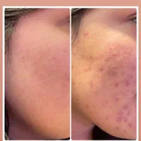 بوتاکس،ژل،چربی،ساکشن غبغب،آموزش سابسیژن پی ارپی|خدمات آرایشگری و زیبایی|اصفهان, شاهزید|دیوار