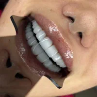 کامپوزیت دندان/ لمینت/ عصب کشی/ زیبایی|خدمات آرایشگری و زیبایی|تهران, تهرانپارس غربی|دیوار