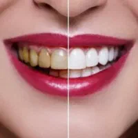 زیبایی دندان