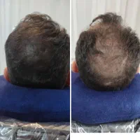 با تکنیک میکرواسکالپ،کم پشتی مو دیگه دیده نمیشه|خدمات آرایشگری و زیبایی|شاهین‌شهر, فردوسی|دیوار