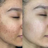 پاکسازی،جوانسازی،پوست کره ای،لک بری،اموزش صفرتاصد