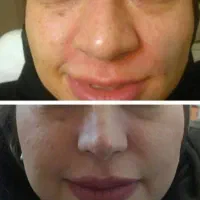 فرم دهی بینی بدون جراحی (عکس قبلتو بده بعدتو ببین)|خدمات زیبایی و سلامت|قم, حاج زینل|دیوار