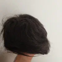 پروتز موی مردانه